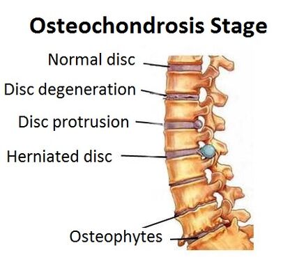 Osteokondroosi etapid